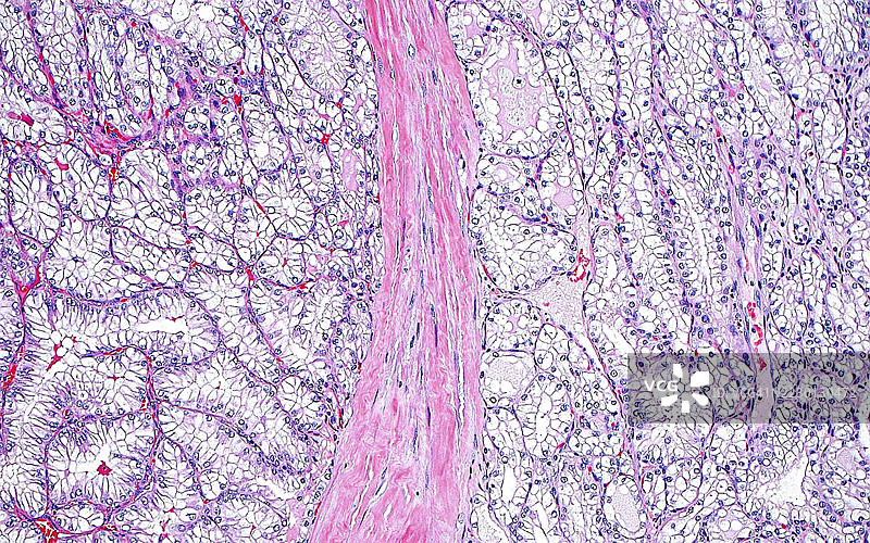 肾癌伴纤维肌瘤 stroma，光学显微镜图像图片素材