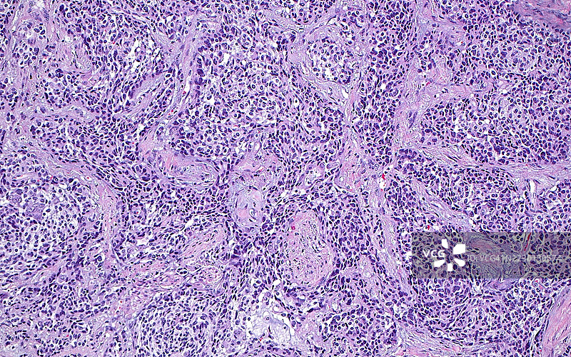 肺类癌肿瘤，光学显微镜图像图片素材