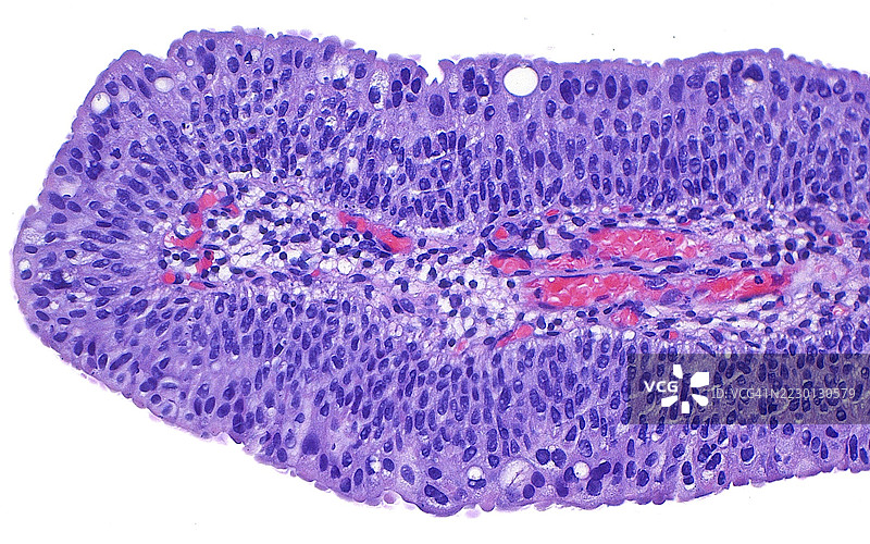 尿路上皮瘤，光学显微镜图像图片素材