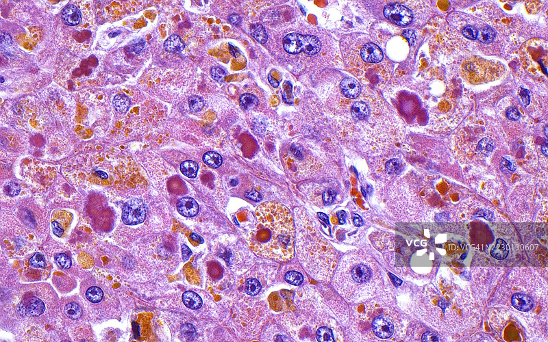 肝细胞癌，光学显微镜图像图片素材