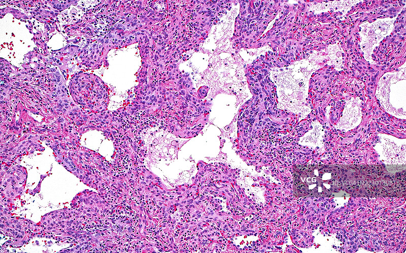 脑膜上皮样肺结节，光学显微镜图像图片素材
