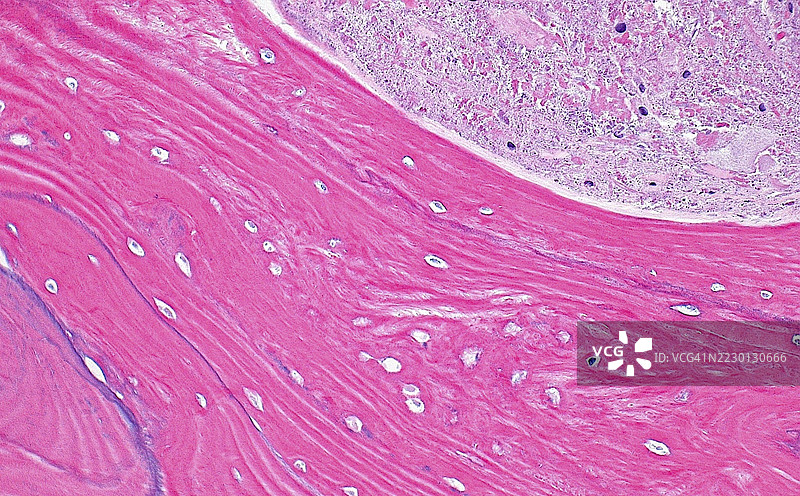 骨坏死，光学显微镜图像图片素材
