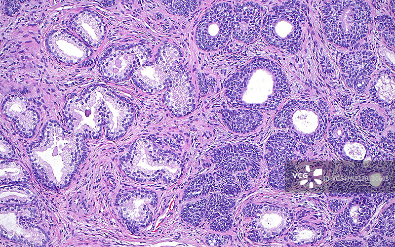 前列腺基底细胞增生，光学显微镜图像图片素材