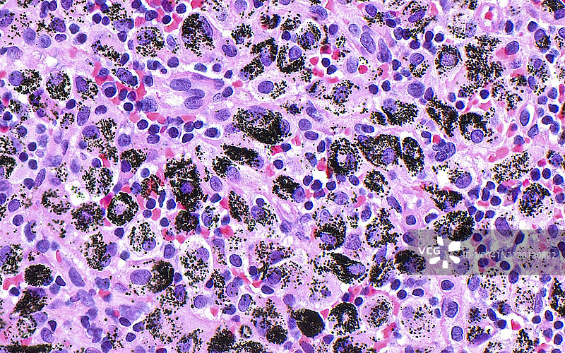 肺淋巴结中的煤尘色素，光学显微镜图像图片素材