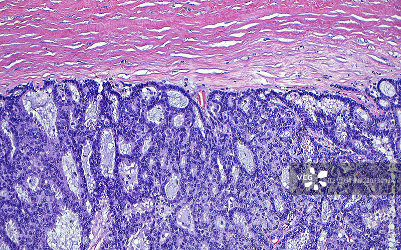 包裹性乳腺癌，光学显微镜图像图片素材