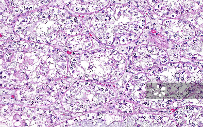 透明细胞子宫腺癌，光学显微镜下图像图片素材