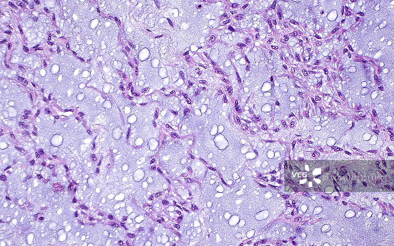 外骨骼黏液样软骨肉瘤，光学显微镜图像图片素材