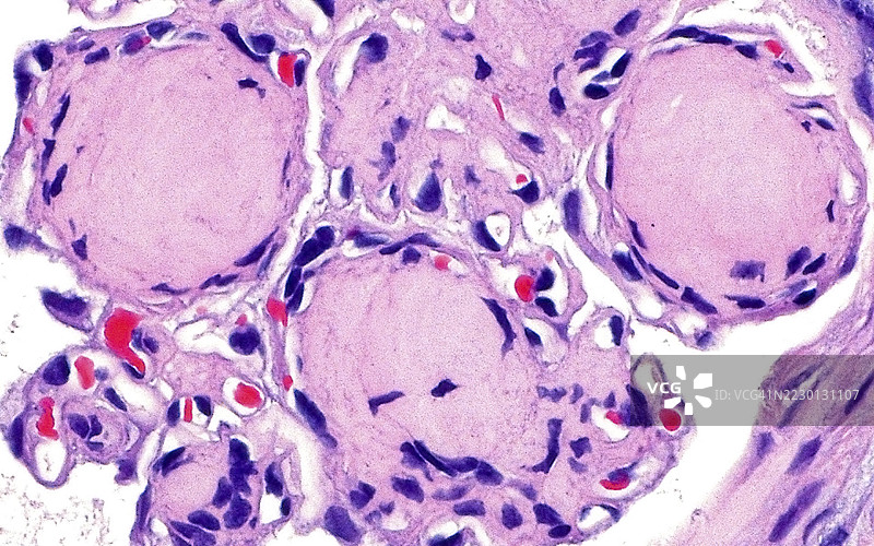 结节性肾小球硬化症，光学显微镜图像图片素材