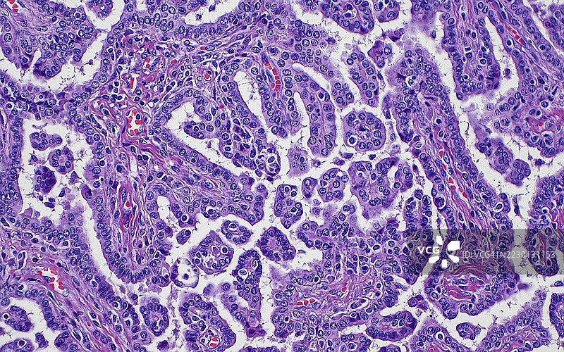 乳 头状肾细胞癌，光学显微镜图像图片素材
