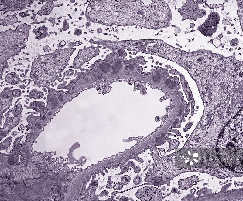 电子显微镜图像显示在肾小球毛细血管的横截面基底膜中发现的免疫蛋白沉积。图片素材
