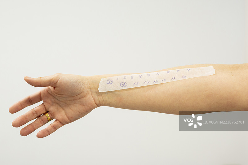 患者在手臂上展示过敏测试结果图片素材