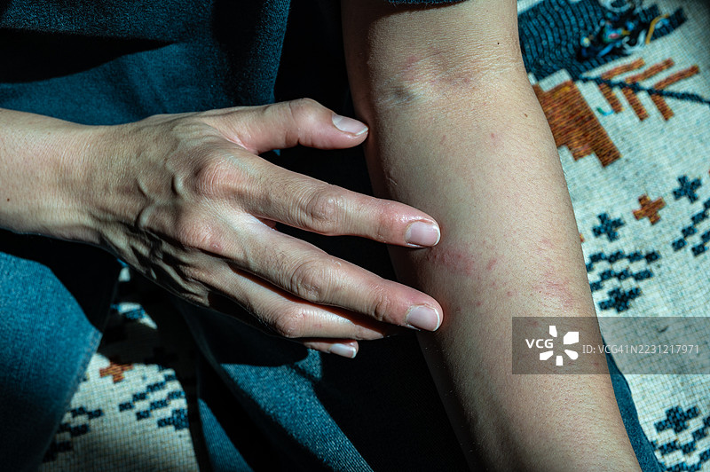 女人抓挠手臂的特写镜头，因为蚊子叮咬感到瘙痒。避免抓挠，因为这可能会加重刺激并可能导致感染。图片素材