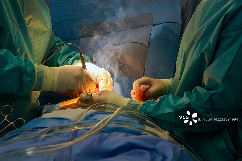 医生们在医院为患者进行手术的特写图片素材