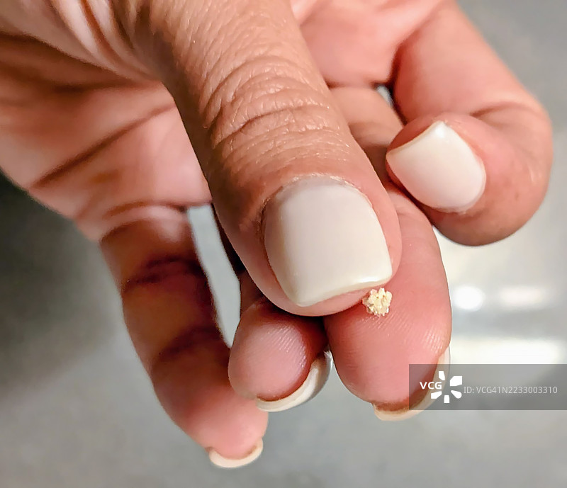 一颗草酸钙肾结石被两根手指夹住图片素材