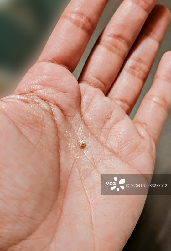 手掌中的草酸钙肾结石图片素材