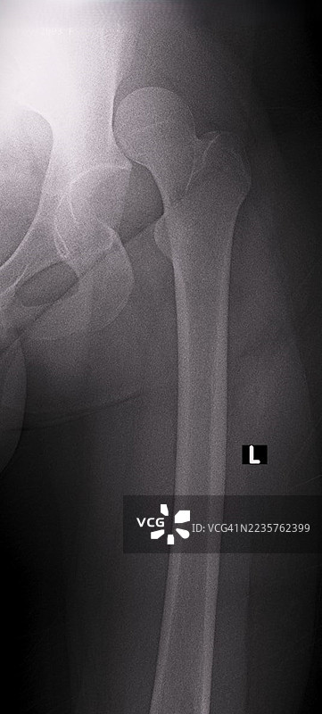 脱位的髋关节，X光片图片素材
