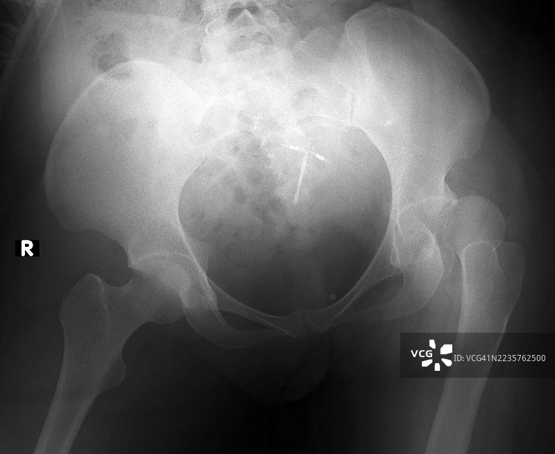 脱位的髋关节，X光片图片素材