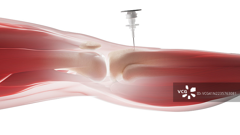 胫骨内骨髓注射插图图片素材