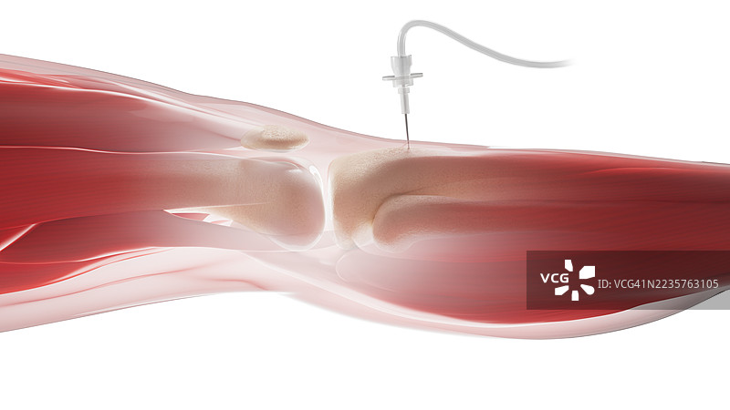 胫骨内骨髓注射插图图片素材