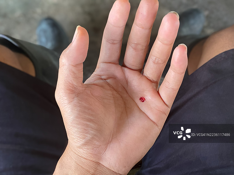 手掌皮肤表面流血的裂伤特写图片素材
