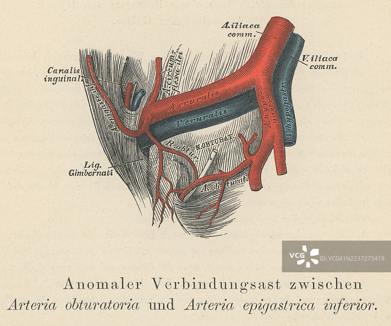 旧版雕刻插图显示了髋动脉（内髋动脉的一个分支）错误的排列方式图片素材