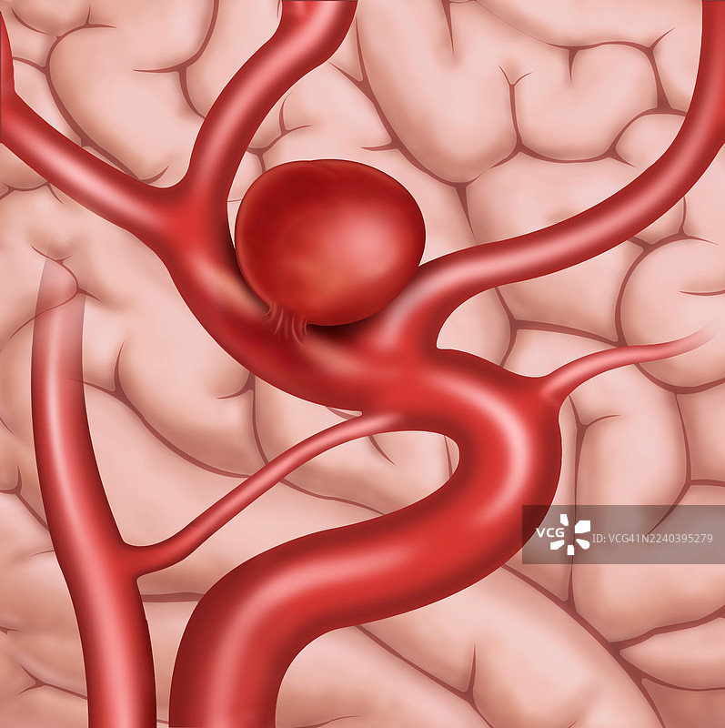 脑动脉瘤，插画图片素材