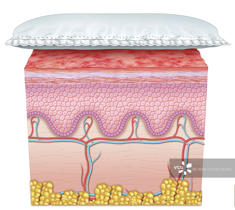 尿布疹，插画图片素材