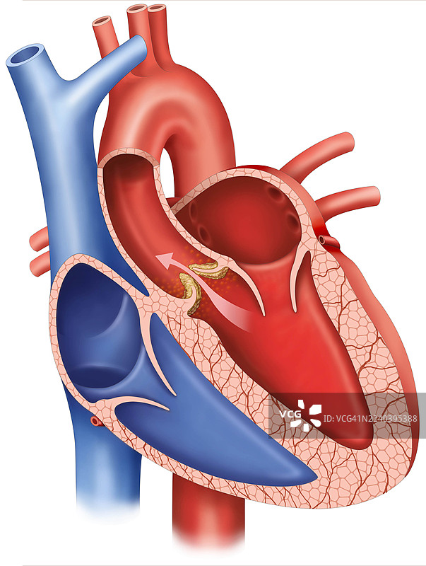 主动脉瓣狭窄，插画图片素材