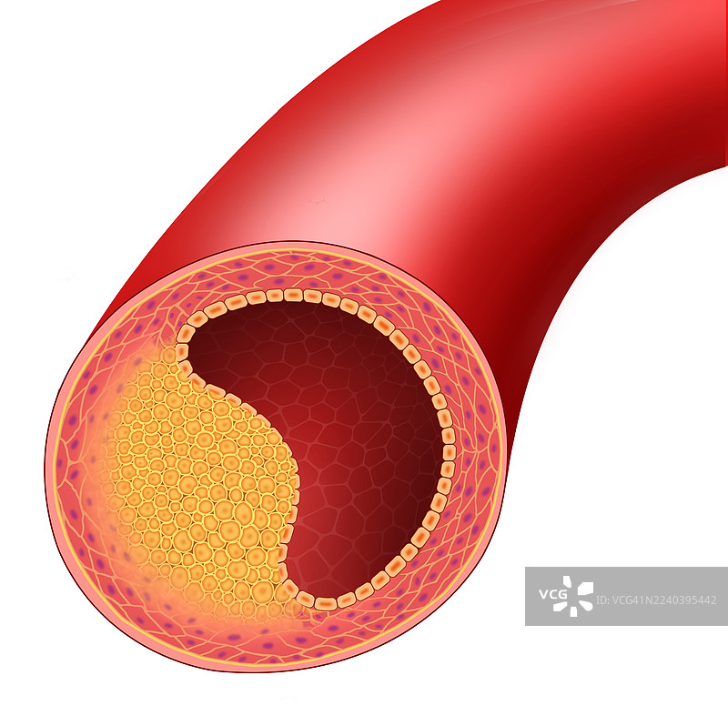 动脉粥样硬化，插画图片素材