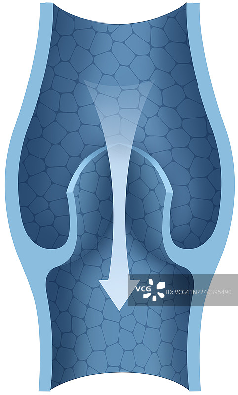 静脉曲张瓣膜，插画图片素材