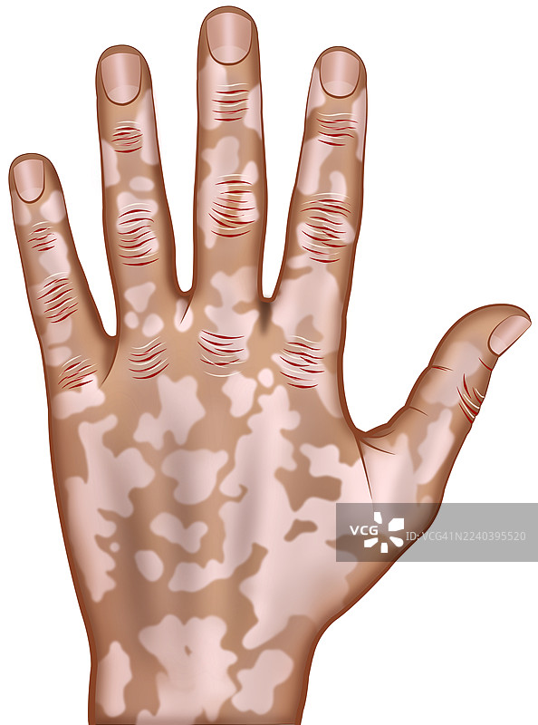 手部白癜风，插画图片素材