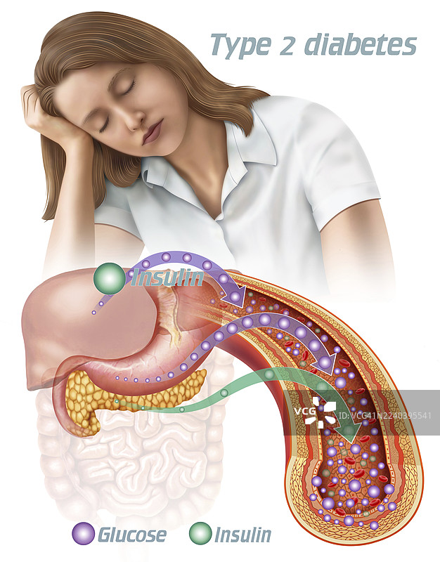 2型糖尿病的年轻女性，插画图片素材