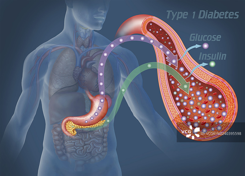 1型糖尿病中的葡萄糖与胰岛素，插画图片素材