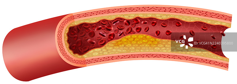 动脉胆固醇堆积，插画图片素材