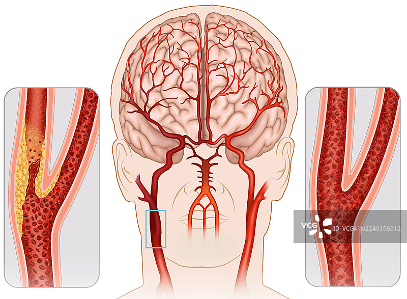 颈动脉粥样硬化，插画图片素材