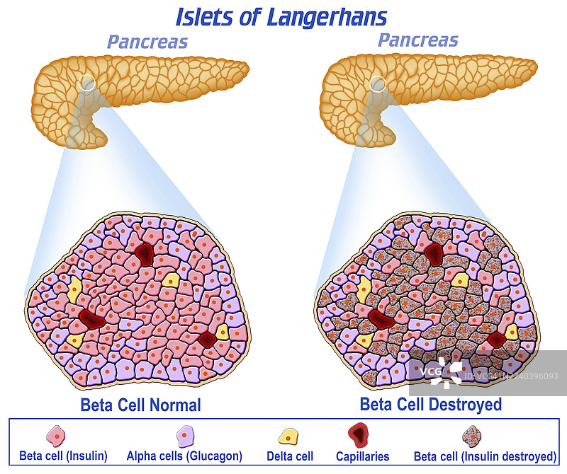 胰腺和朗格汉斯岛在糖尿病中的作用，插画图片素材
