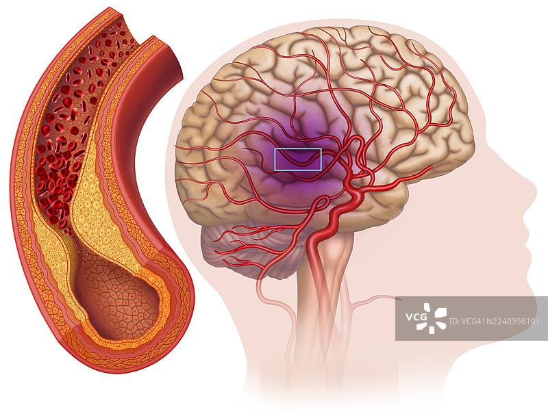 胆固醇与中风，插画图片素材