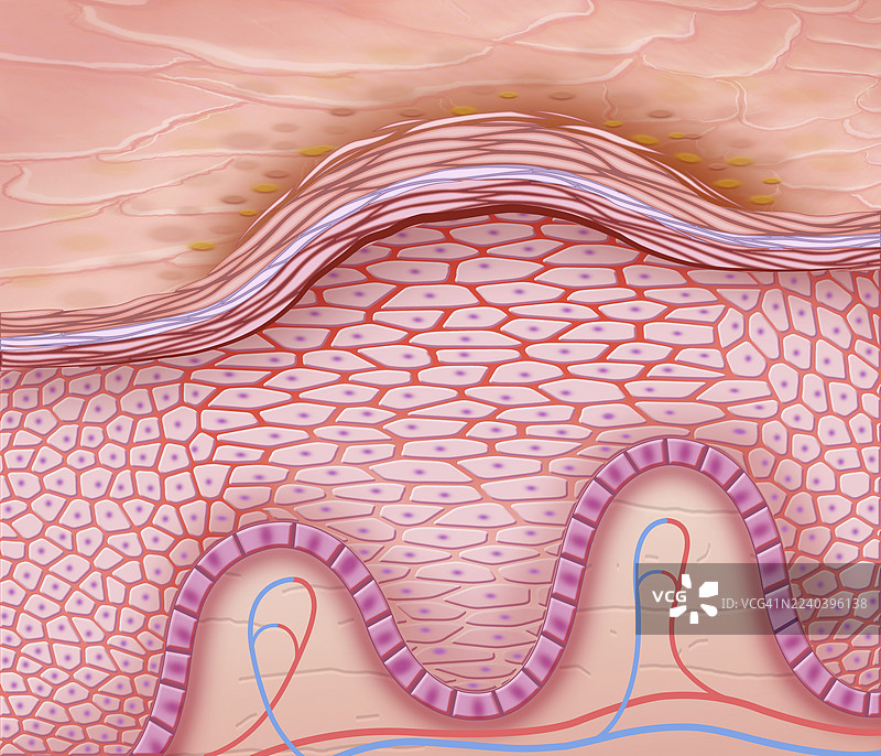 达里埃病，插画图片素材