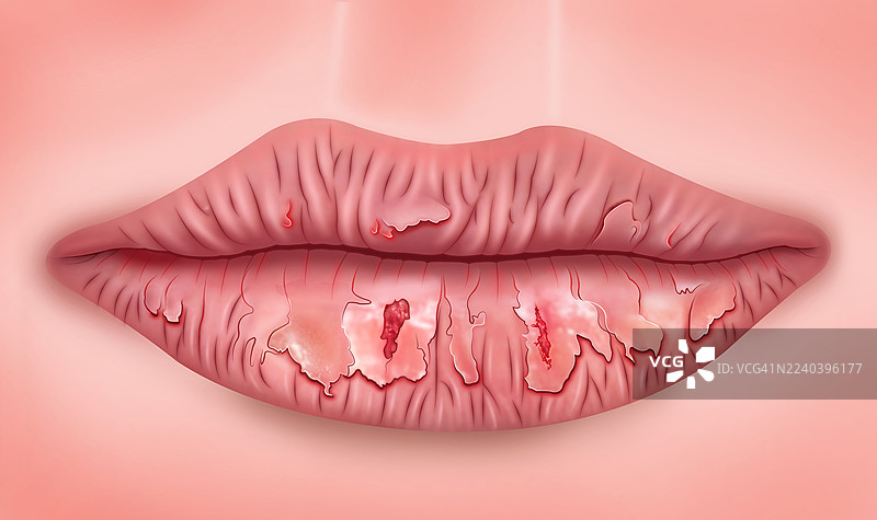 舍格伦综合征引起的唇部干裂，插画图片素材