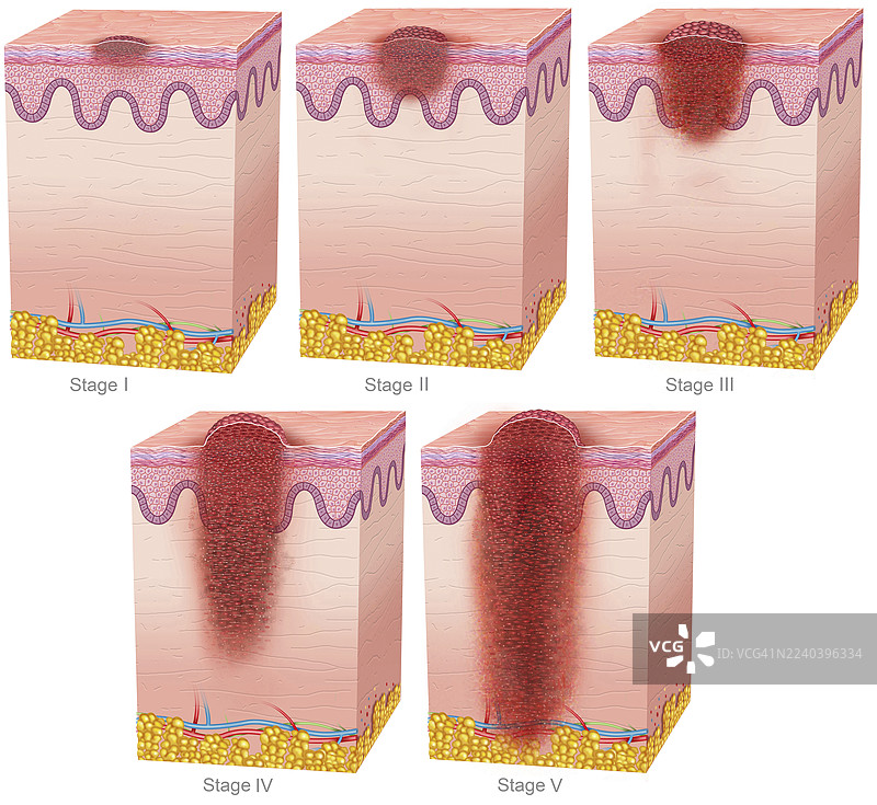 黑色素瘤的五个阶段，插画图片素材