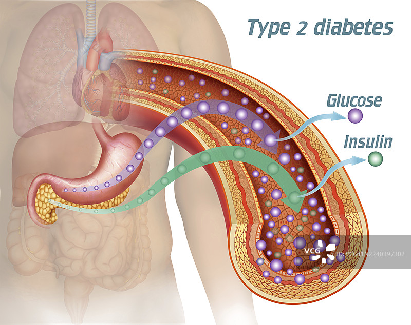 2型糖尿病中胰岛素抵抗的插画图片素材