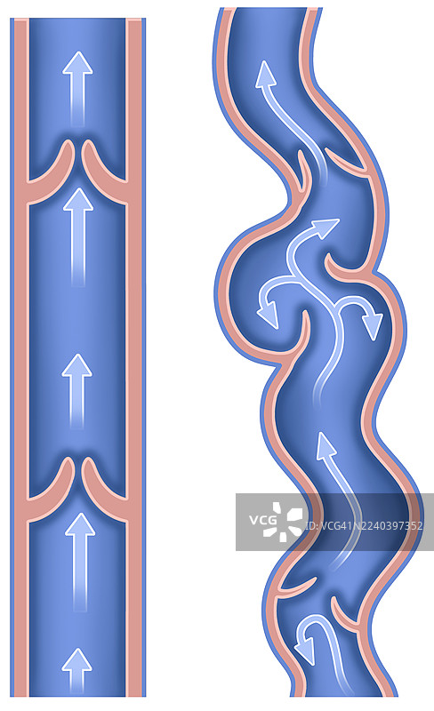 健康和静脉曲张的静脉，插画图片素材