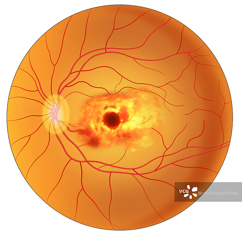 湿性年龄相关性黄斑变性，插画图片素材