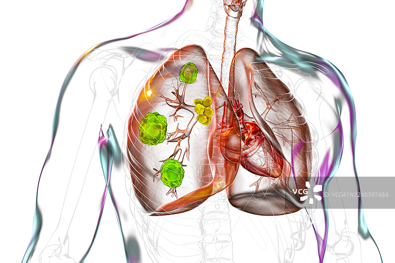 肺曲霉菌病，插画图片素材