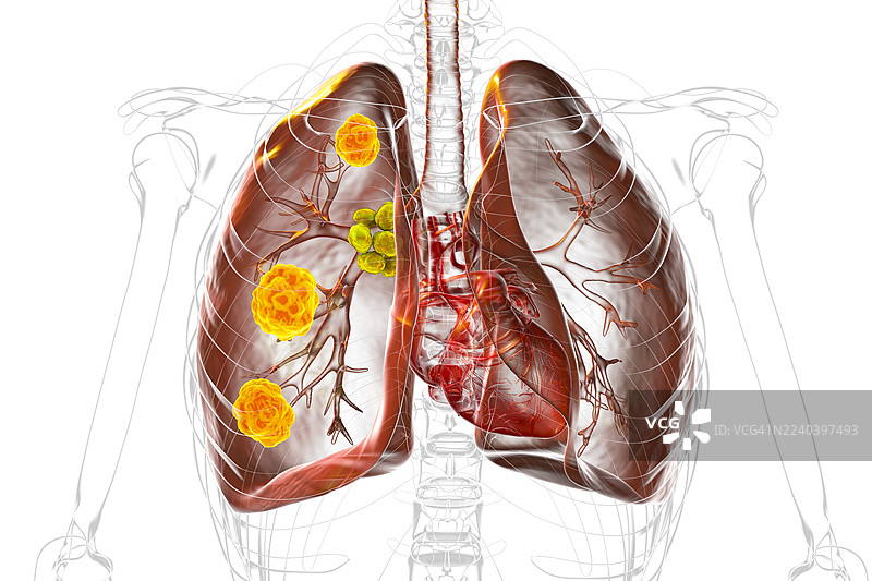 肺曲霉菌病，插画图片素材
