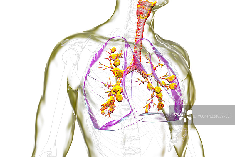 囊性纤维化影响的肺部，插画图片素材