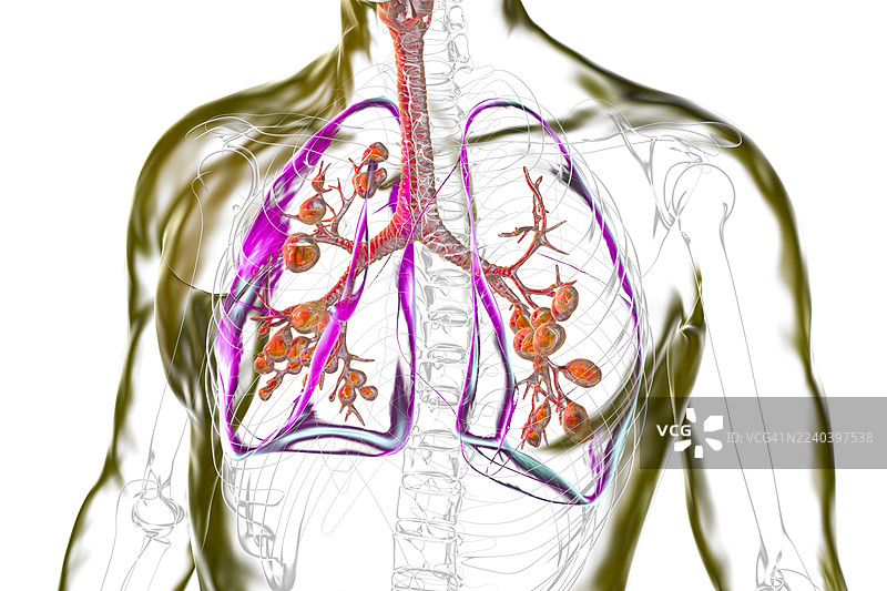 囊性纤维化影响的肺部，插画图片素材