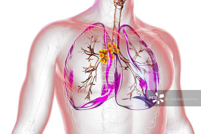纵隔淋巴结炎，插画图片素材