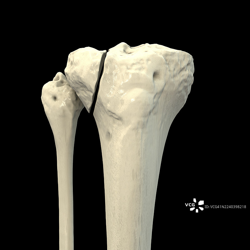 胫骨骨折 Schatzker I 型，插画图片素材