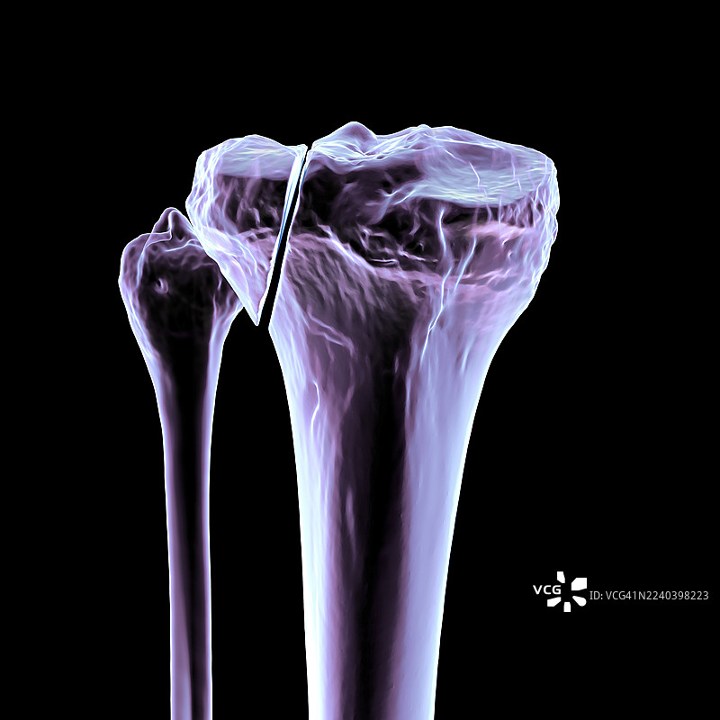 胫骨骨折 Schatzker I 型，插画图片素材